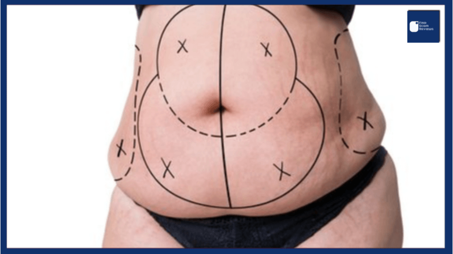 Do you lose weight after liposuction 